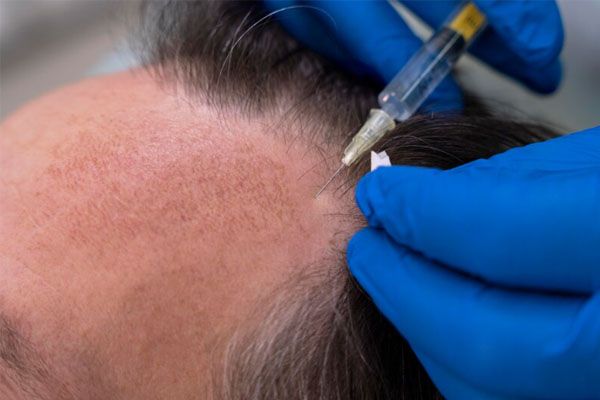 Primo-piano-di-un-uomo-sottoposto-a-trattamento-per-la-caduta-dei-capelli