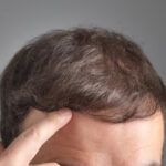 Quanti follicoli servono per ottenere un risultato