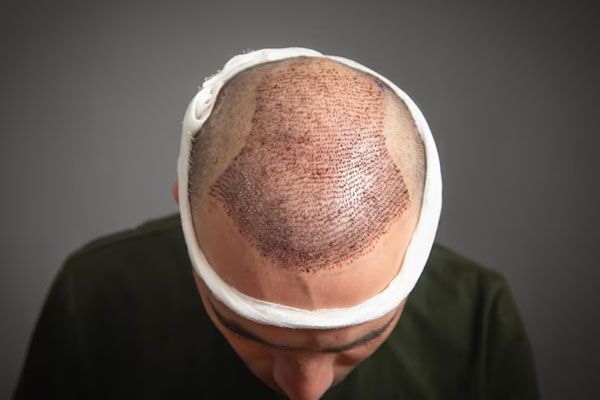Uomo caucasico dopo trapianto di capelli - 