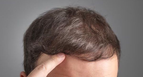 miglior trapianto capelli Turchia