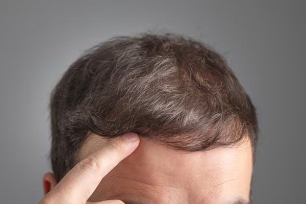 primo piano dei capelli di un uomo indicati dal suo stesso dito - trapianto capelli Roma costi