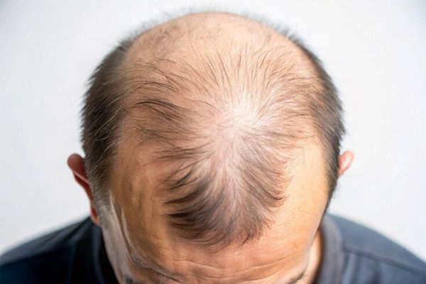 primo piano di una testa con alopecia - Quanti follicoli servono per ottenere un risultato 