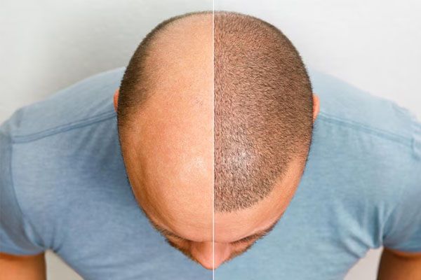 testa di un uomo calvo prima e dopo l'intervento di trapianto di capelli