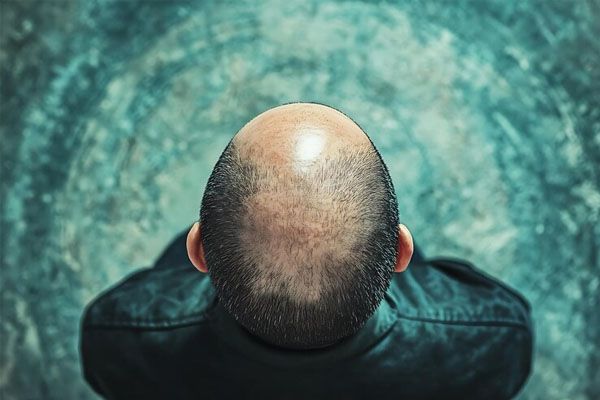 vista dall'alto della testa di un uomo con i capelli corti su uno sfondo blu - migliori cliniche trapianto capelli Italia