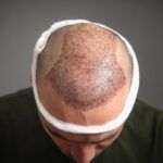 fase di recupero dopo il trapianto di capelli