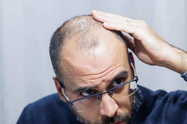 giovane uomo con alopecia che si guarda la testa i capelli lo specchio - i capelli cadano dopo il trapianto
