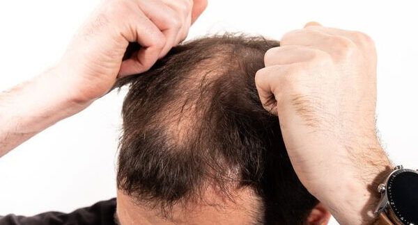 i capelli cadano dopo il trapianto