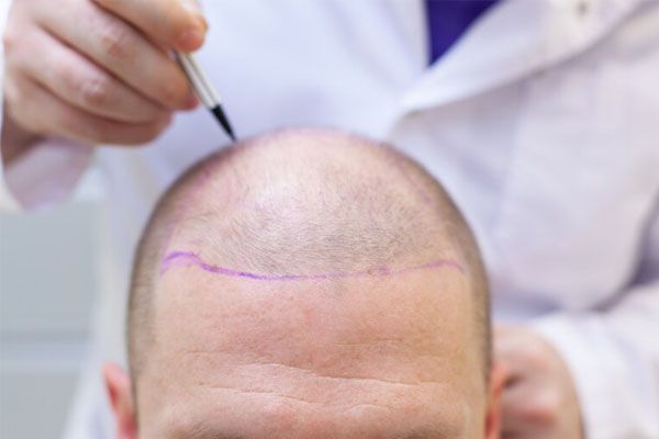 preparazione all'intervento di trapianto di capelli - trapianto capelli Italia