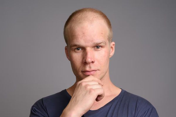 uomo calvo che indossa una camicia blu contro un muro grigio - Trapianto di capelli nei minori di 30 anni