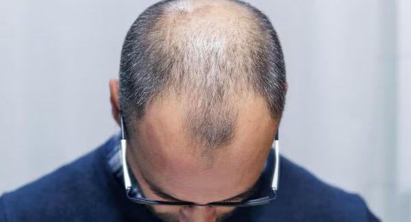 Primo piano di un uomo con alopecia con la testa abbassata