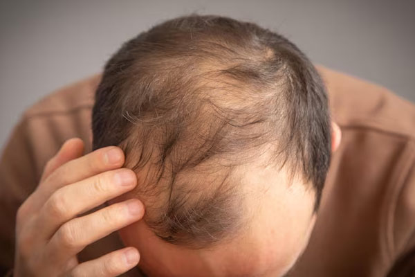 Uomo caucasico con problemi di perdita di capelli