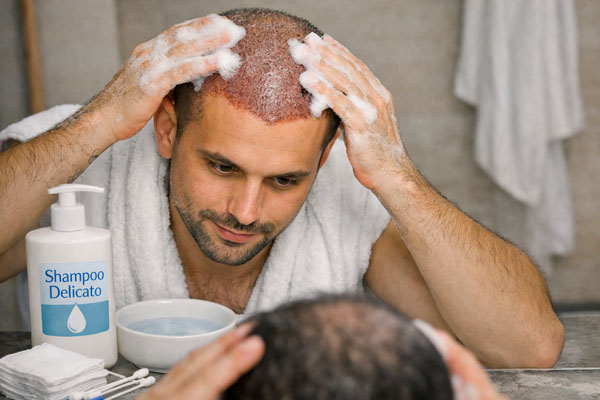 Trattamento medico dopo un trapianto di capelli