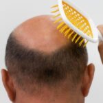 Il costo del trapianto di capelli varia in base all’età e al tipo di calvizie