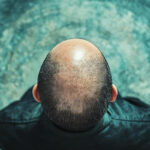 Il trapianto di capelli è consigliato per chi soffre di alopecia androgenetica