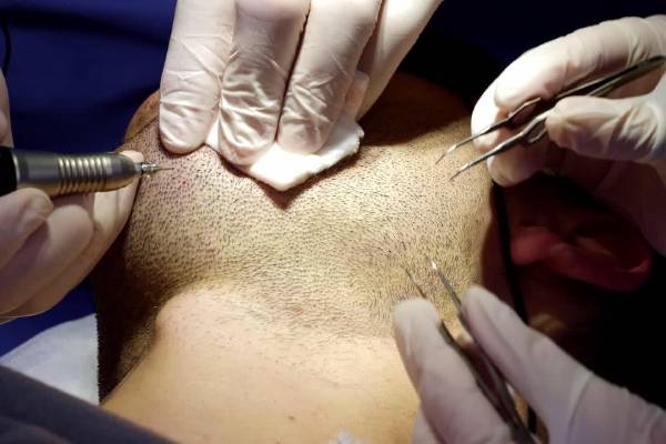 Estrazione di follicoli dalla barba