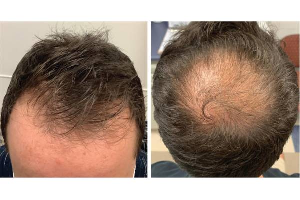 Esempio di alopecia androgenetica maschile