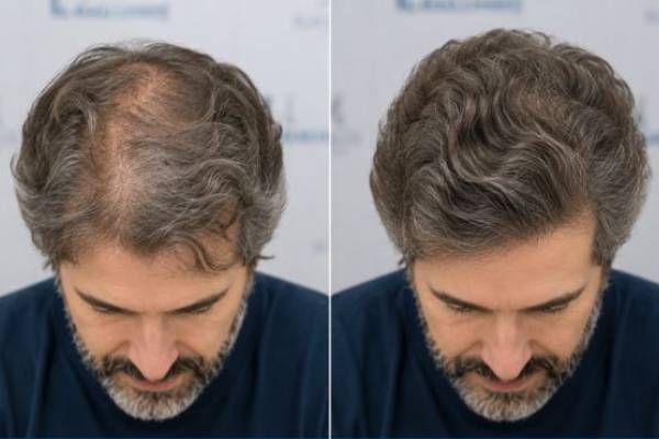 Risultati estetici prima e dopo un trapianto senza rasatura