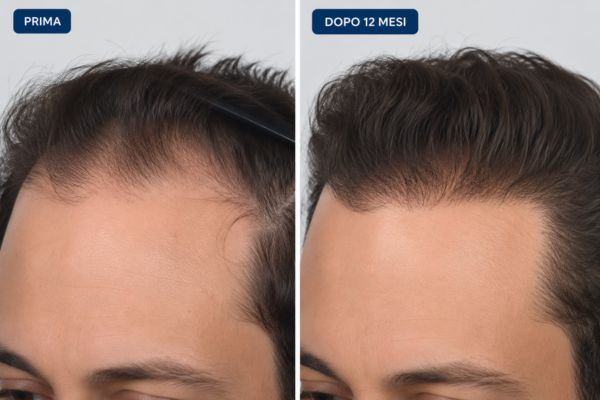 Prima e dopo di un trapianto di capelli