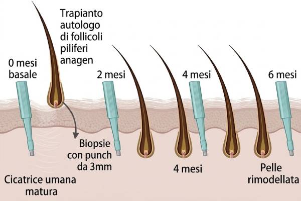 Illustrazione schematica dei follicoli piliferi e della linea cicatriziale per spiegare il principio della sutura tricofitica